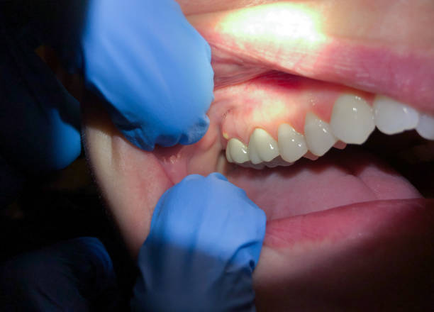Best Emergency Wisdom Tooth Extraction in Huron, CA