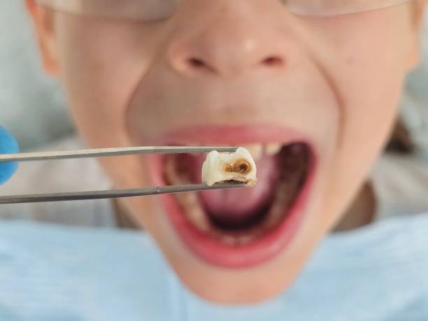 Best Dental Abscess Treatment in Huron, CA