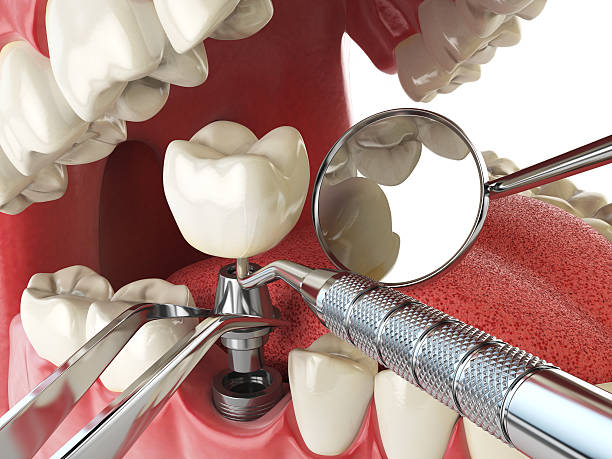Best Knocked-Out Tooth (Avulsed Tooth) Treatment in Huron, CA